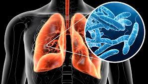 Infezione legionella